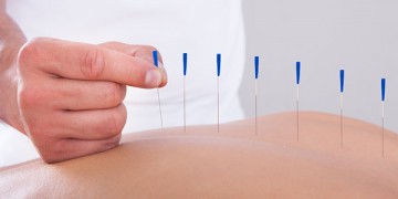 acupunctură