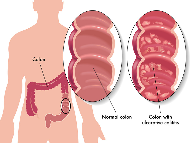 cancer de colon