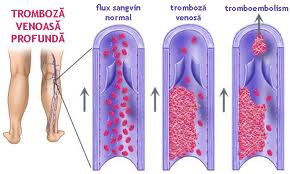 Tromoboza Venoas Profund InfoZOOM ro